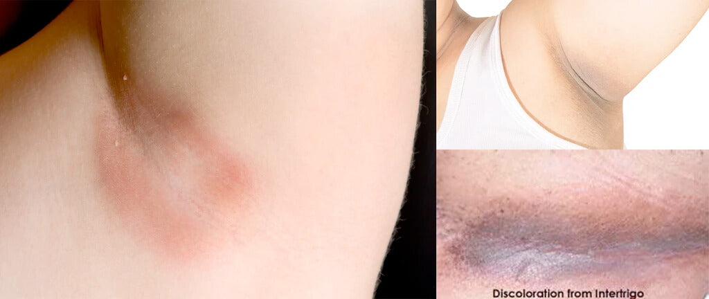 Skin Friction Rash Intertrigo Symptoms & Treatment